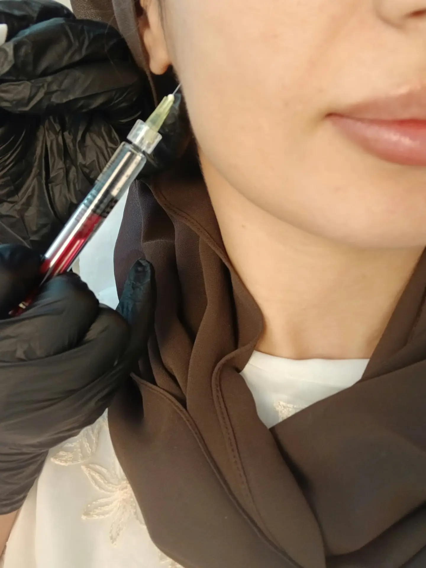 Skinbooster-behandling langs kjevelinjen